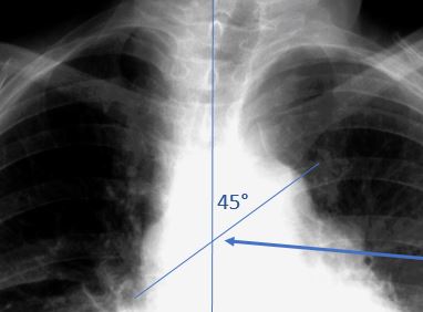 Interpretacion de Radiografia de Torax para Kinesiologos y Otros Profesionales de la Salud